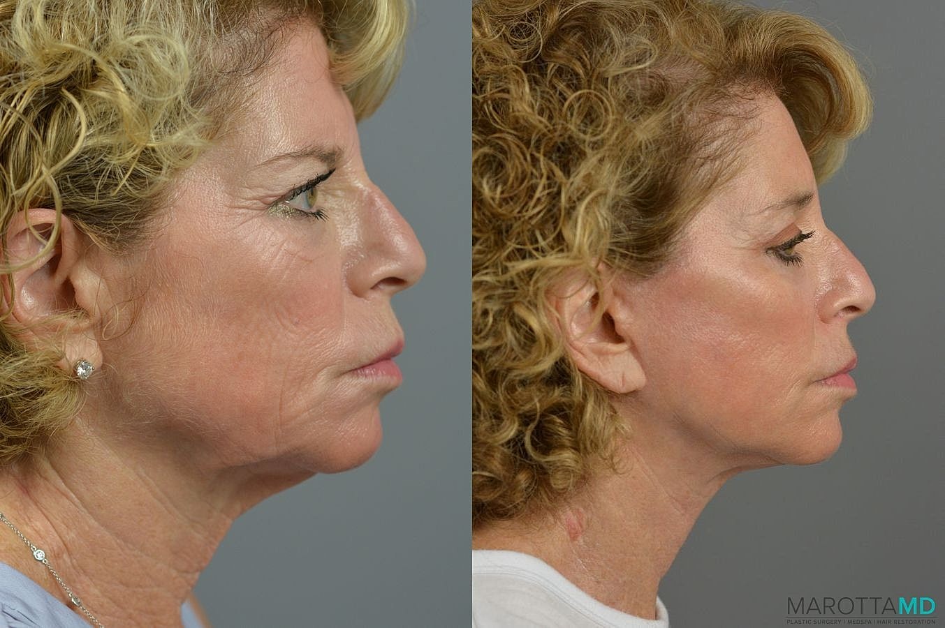 Facelift Neck Lift Before & After