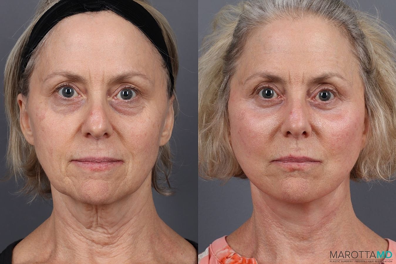 Facelift Neck Lift Before & After