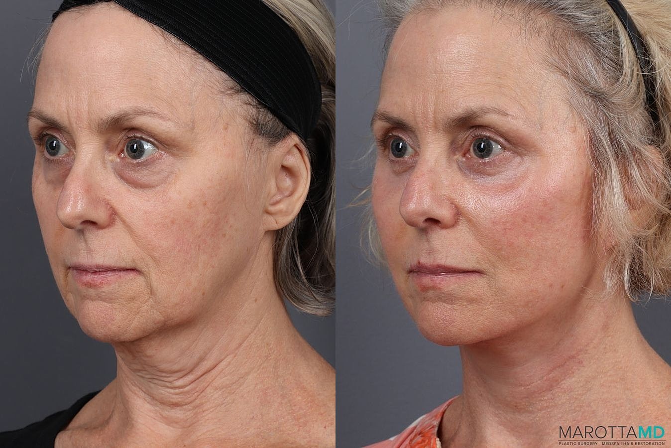 Facelift Neck Lift Before & After