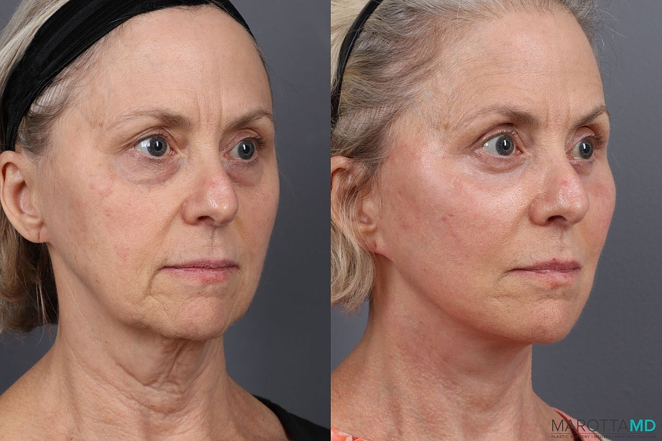 Facelift Neck Lift Before & After