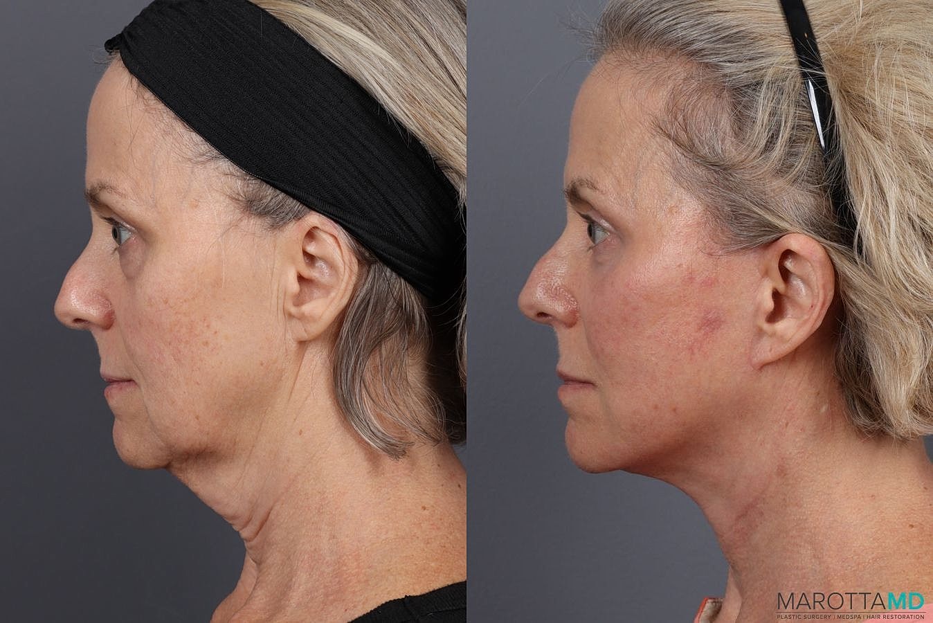 Facelift Neck Lift Before & After