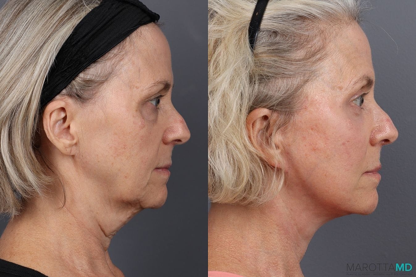 Facelift Neck Lift Before & After