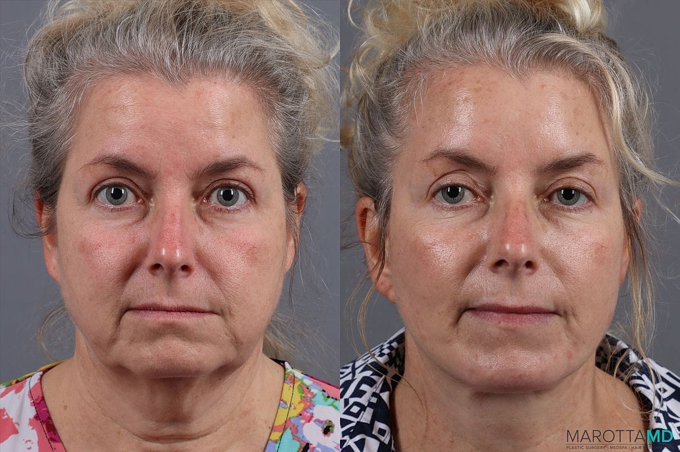 Facelift Neck Lift Before & After
