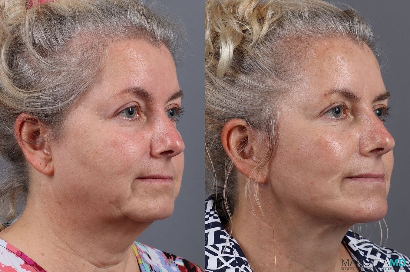 Facelift Neck Lift Before & After