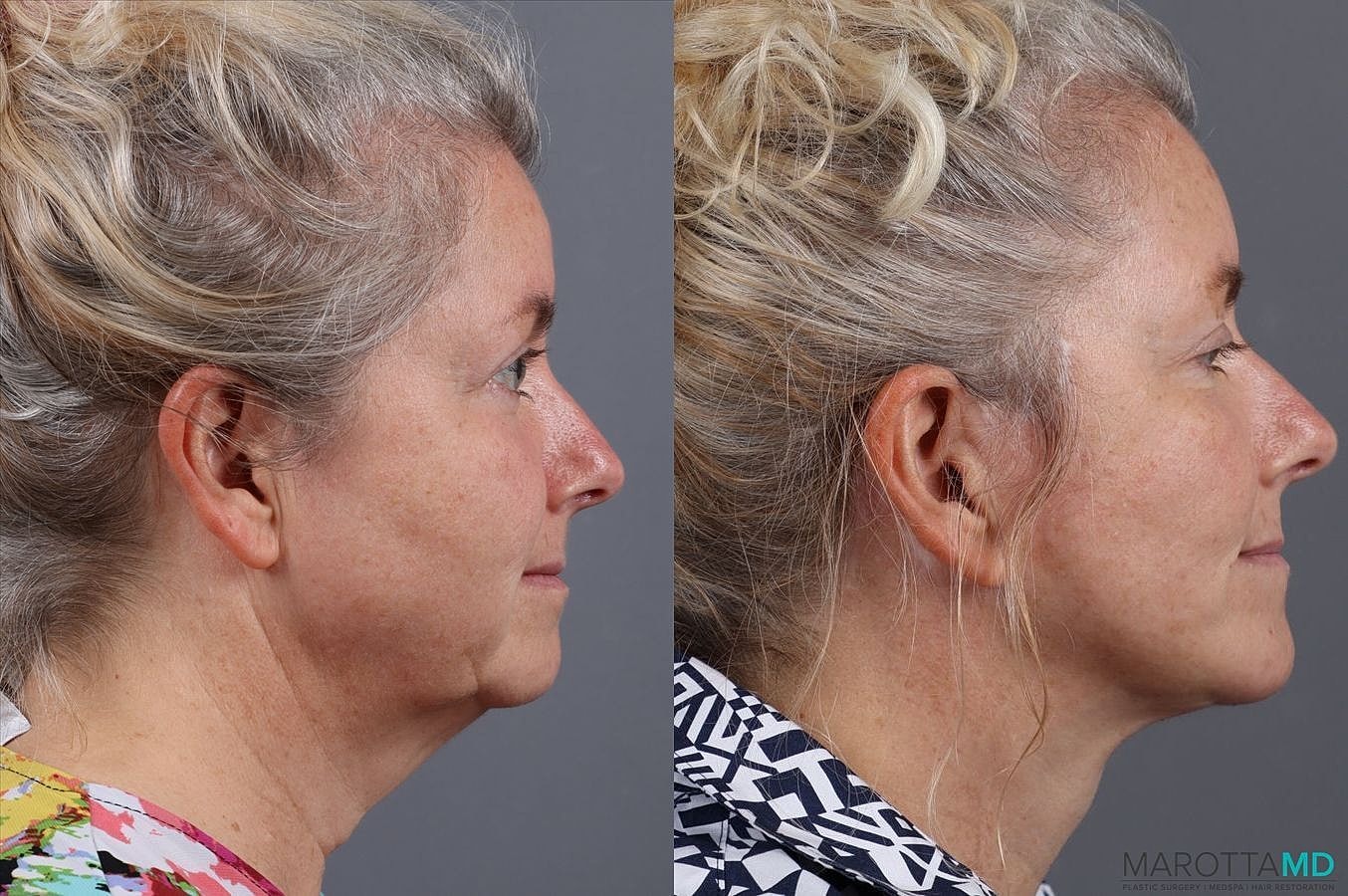 Facelift Neck Lift Before & After