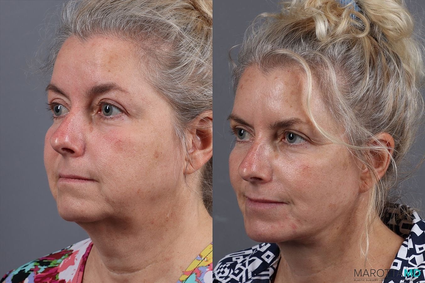 Facelift Neck Lift Before & After