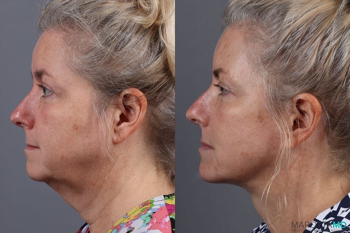 Facelift Neck Lift Before & After