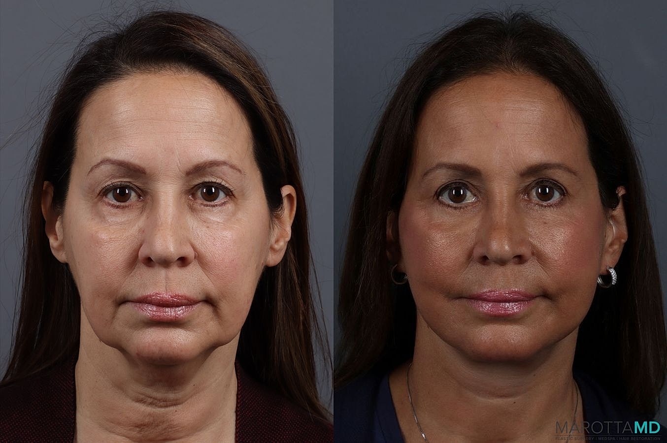 Facelift Neck Lift Before & After