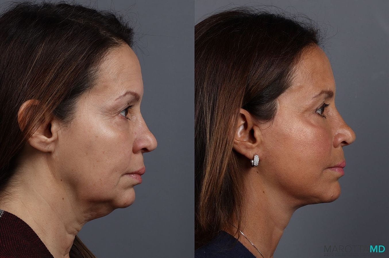 Facelift Neck Lift Before & After