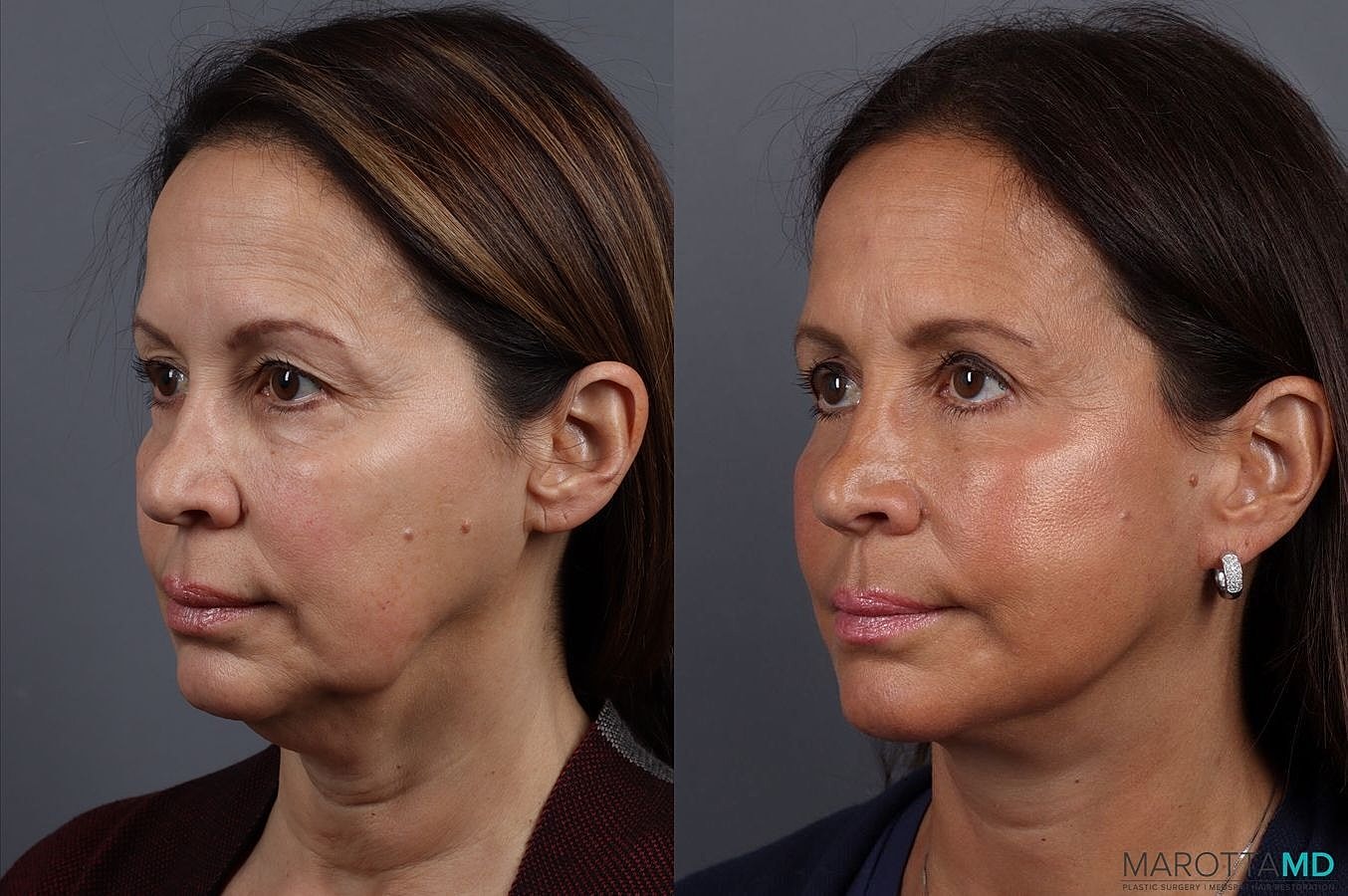 Facelift Neck Lift Before & After