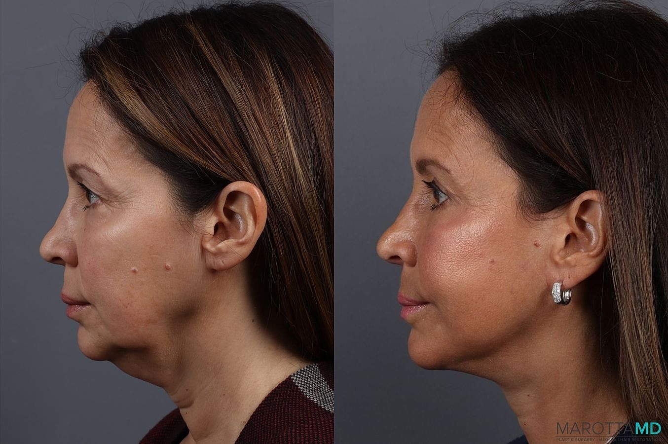 Facelift Neck Lift Before & After