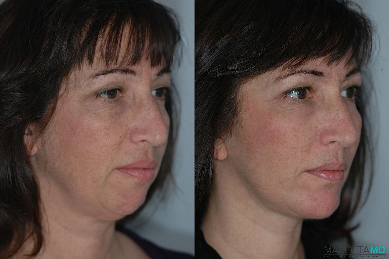 Facelift Neck Lift Before & After