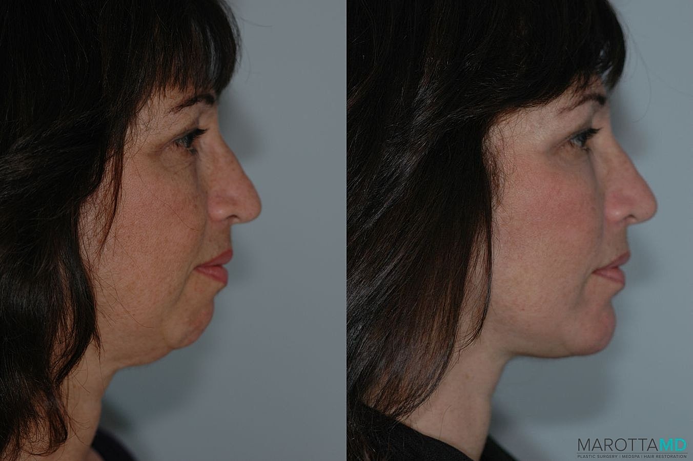 Facelift Neck Lift Before & After