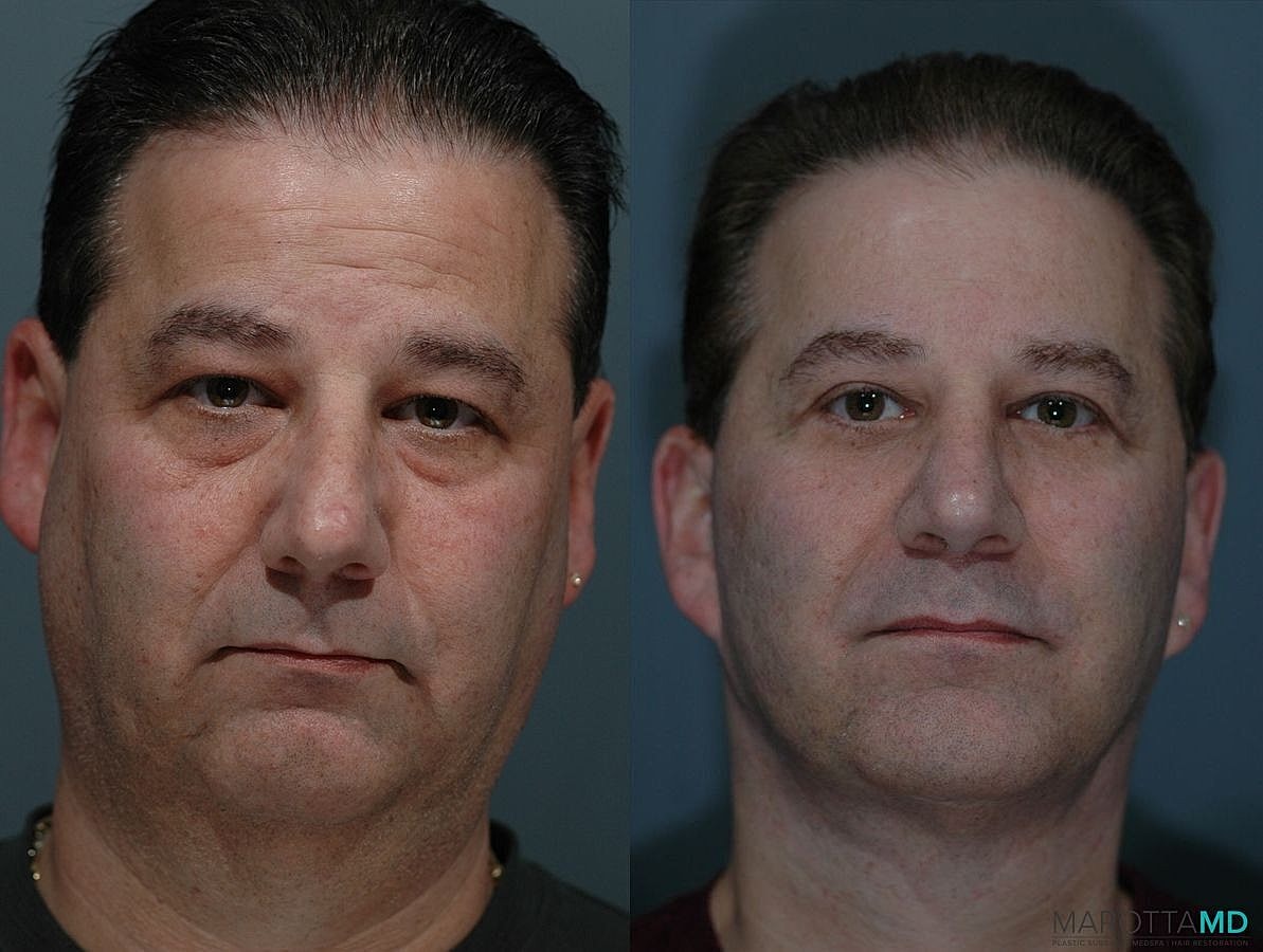 Facelift Neck Lift Before & After