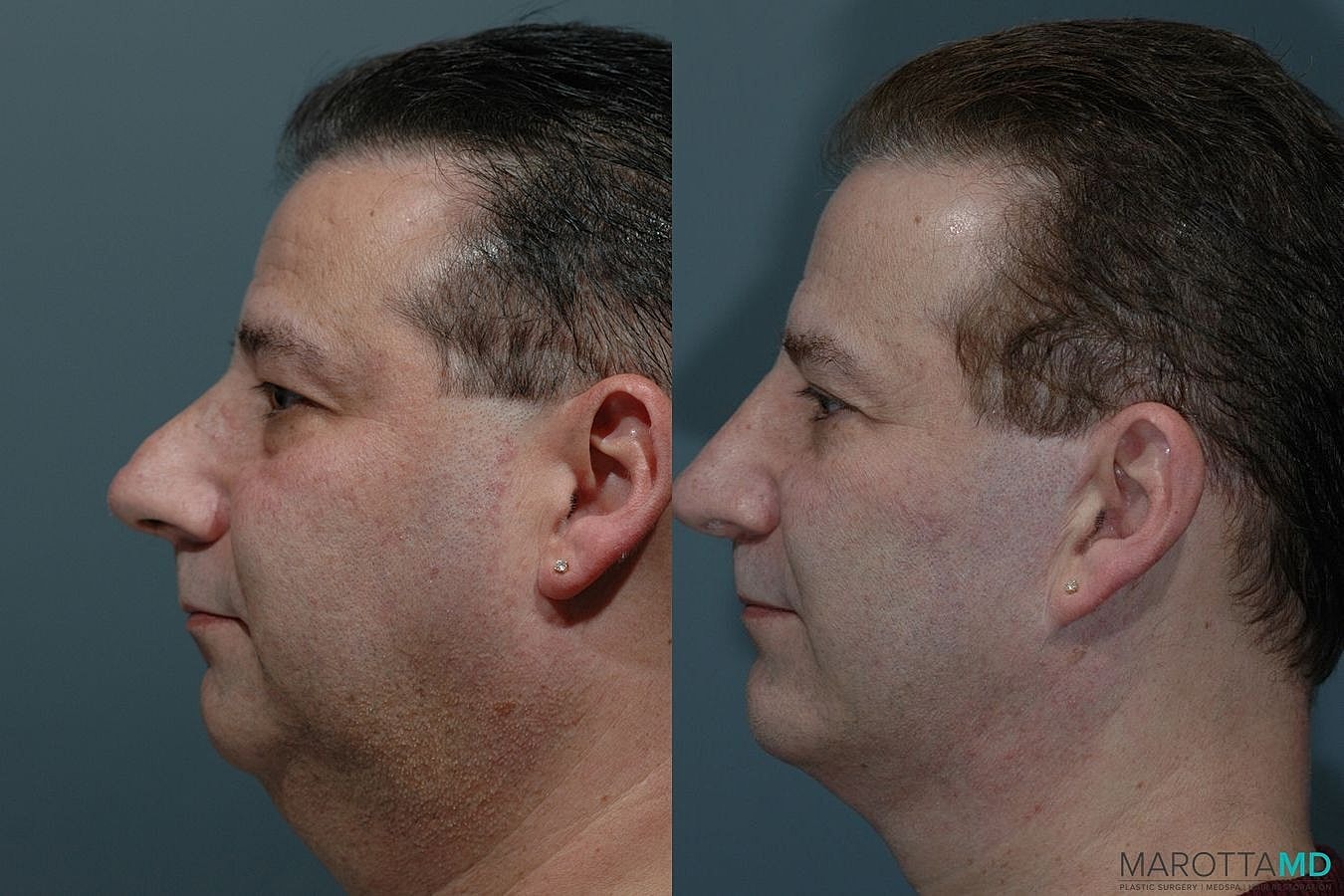 Facelift Neck Lift Before & After