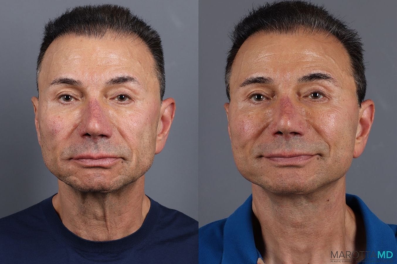 Facelift Neck Lift Before & After
