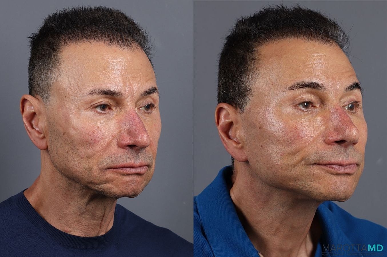 Facelift Neck Lift Before & After