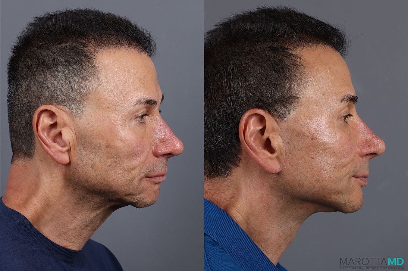 Facelift Neck Lift Before & After