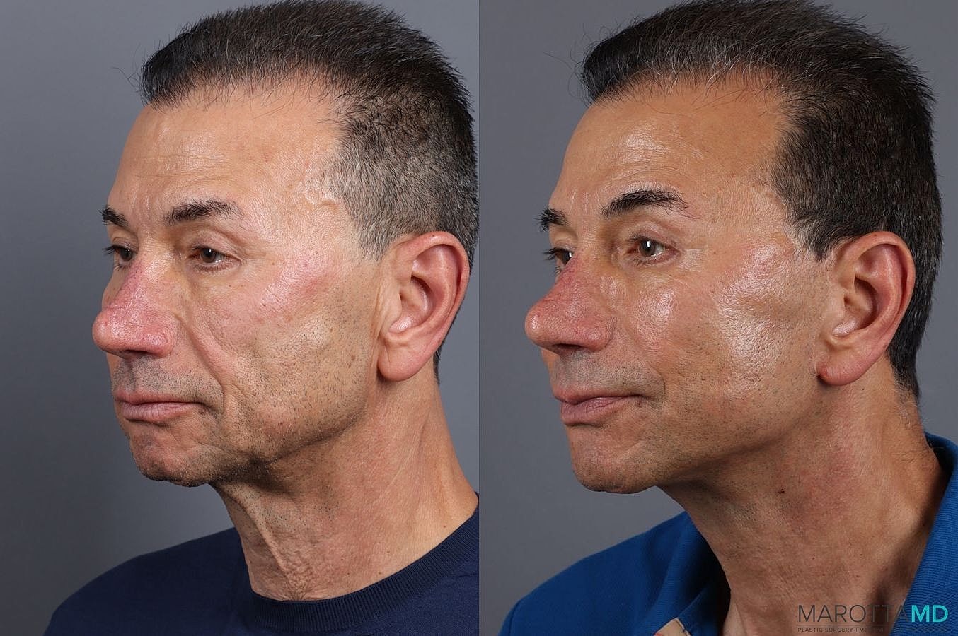 Facelift Neck Lift Before & After