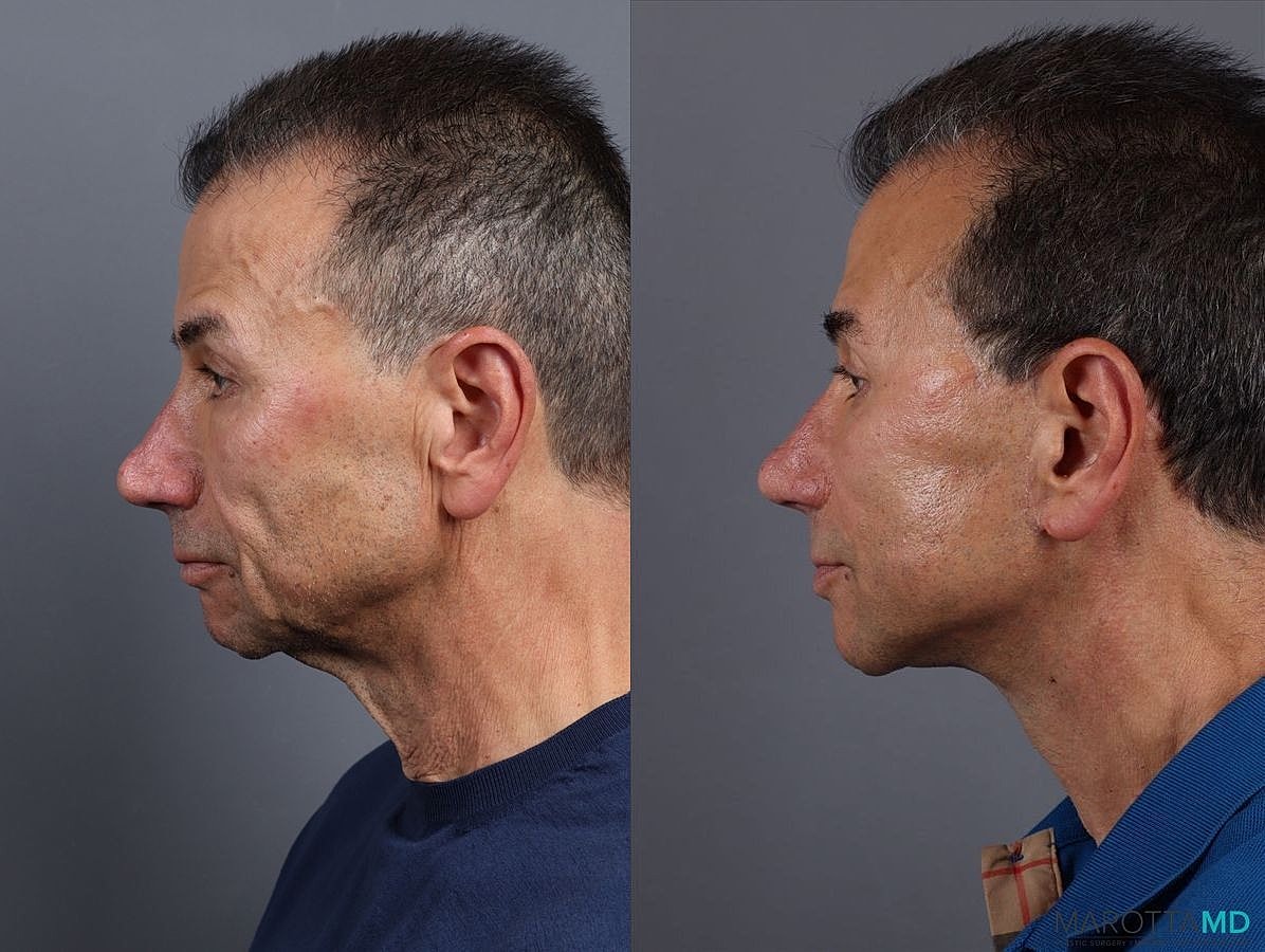 Facelift Neck Lift Before & After