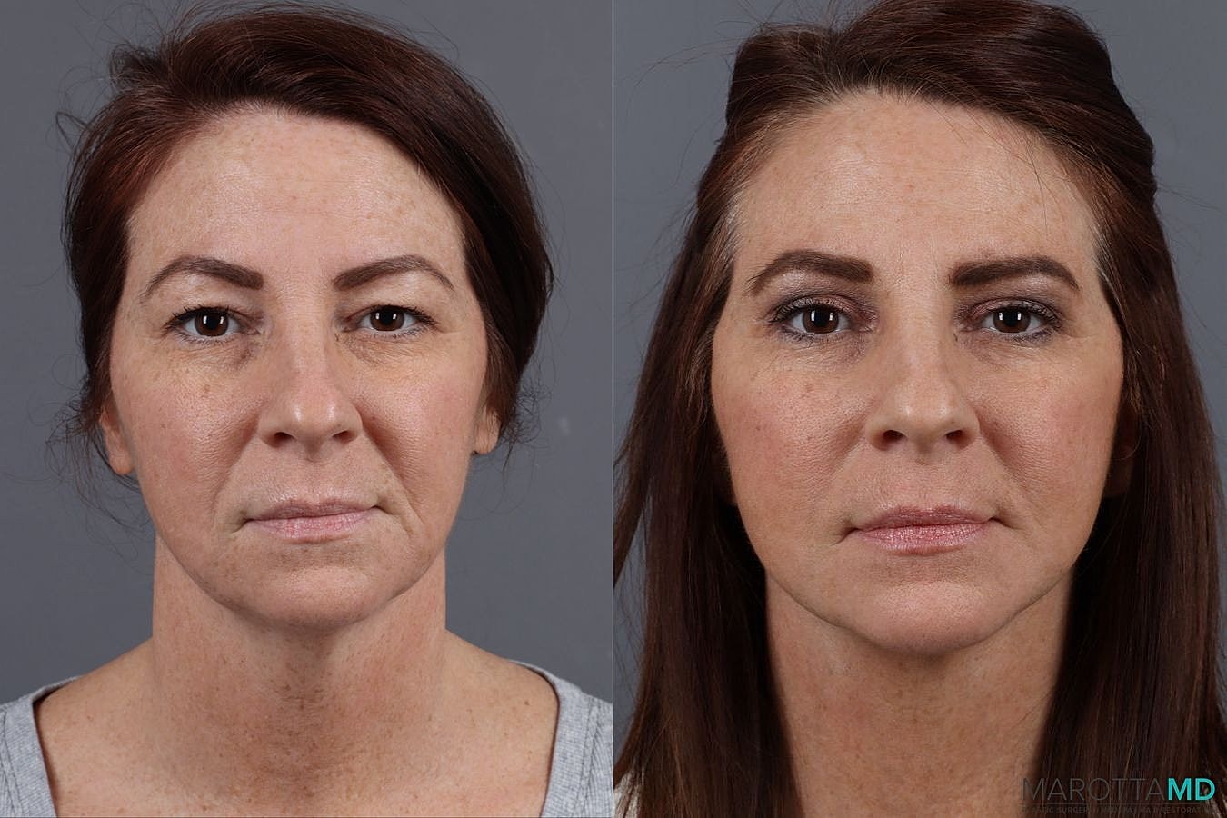Facelift Neck Lift Before & After