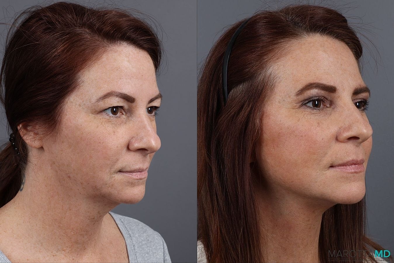 Facelift Neck Lift Before & After