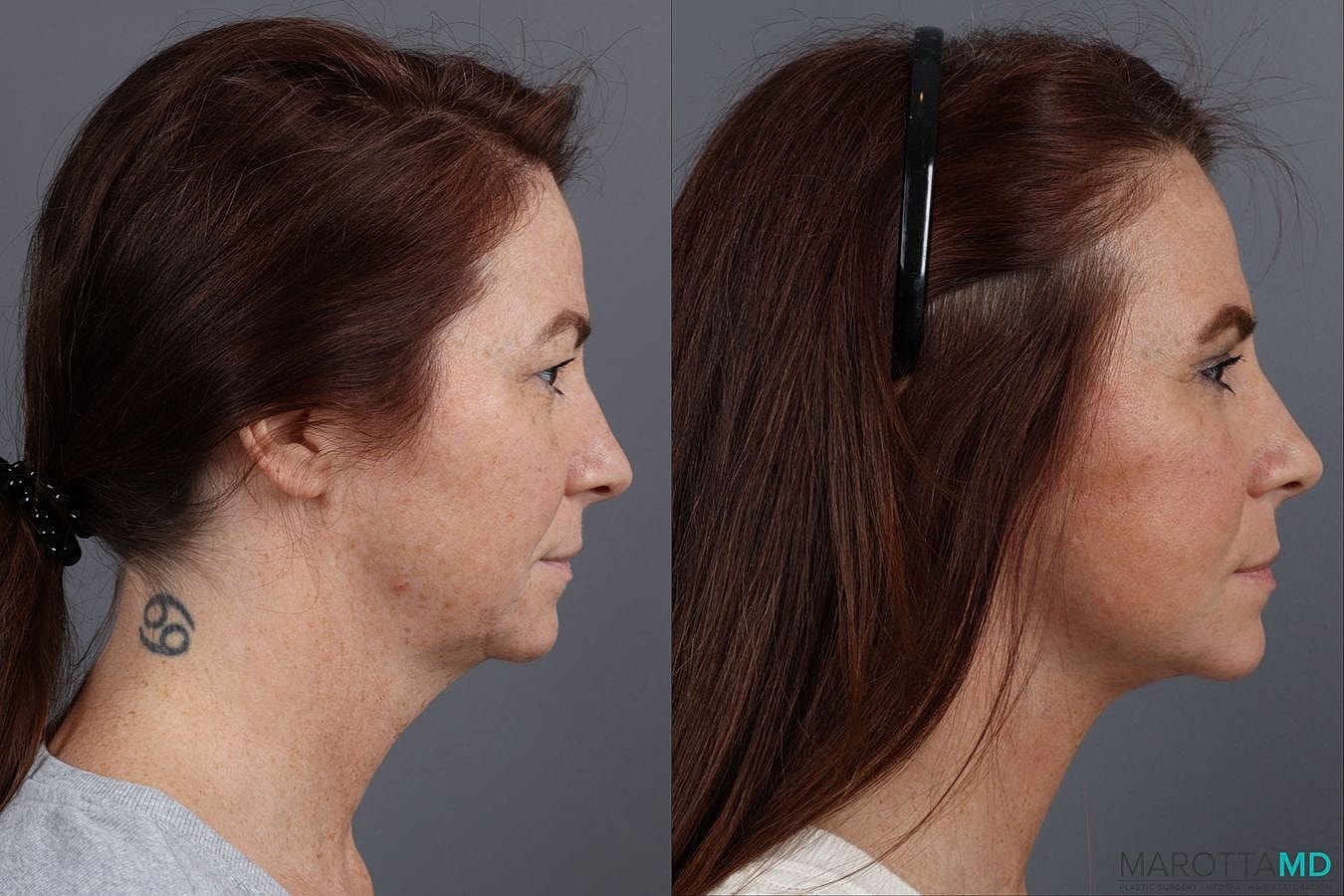 Facelift Neck Lift Before & After