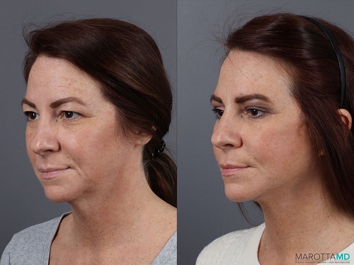 Facelift Neck Lift Before & After
