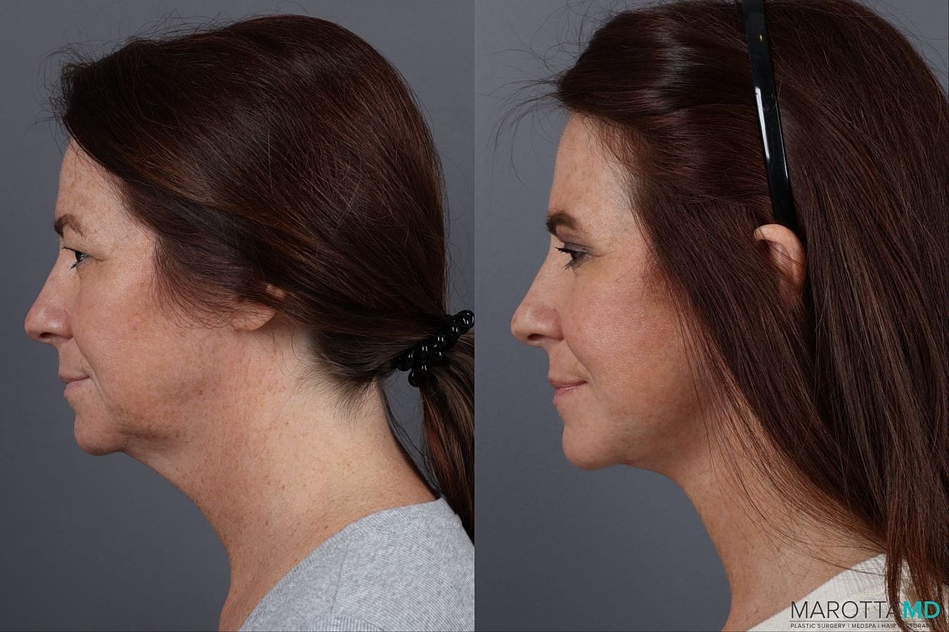Facelift Neck Lift Before & After