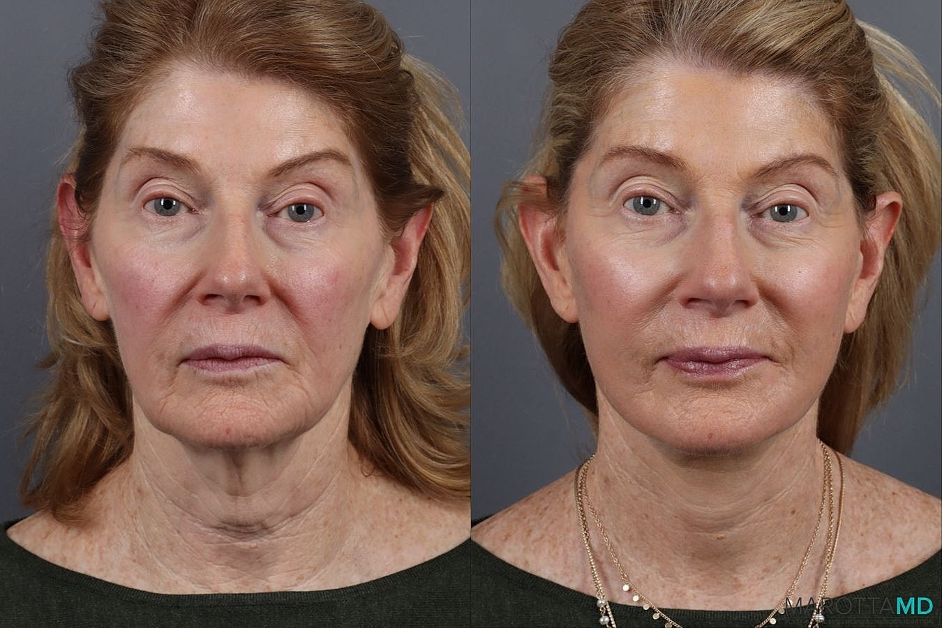 Facelift Neck Lift Before & After