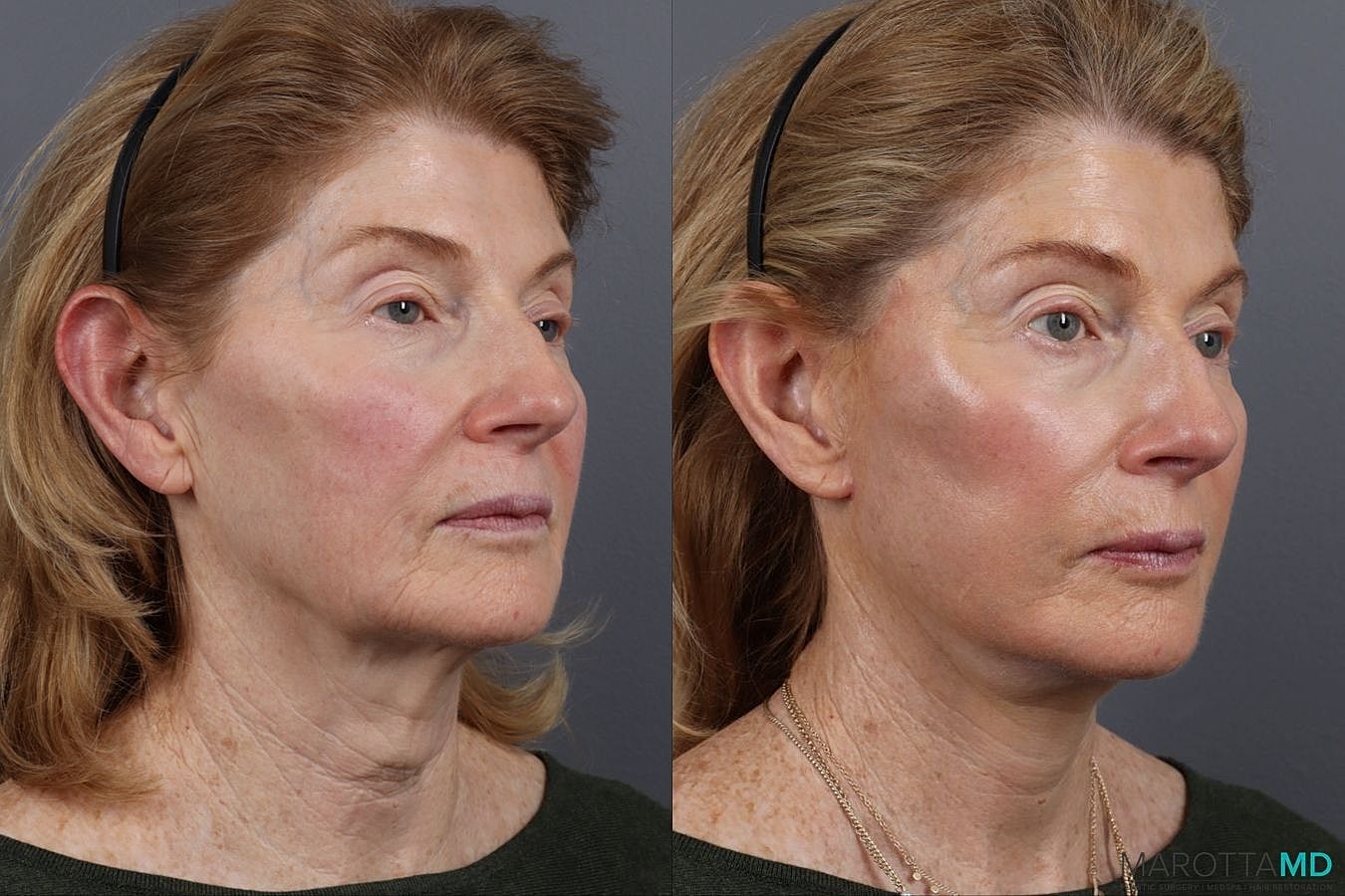 Facelift Neck Lift Before & After