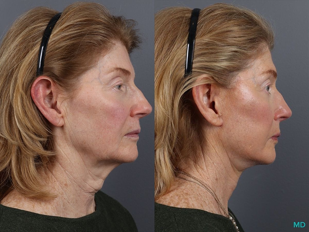Facelift Neck Lift Before & After