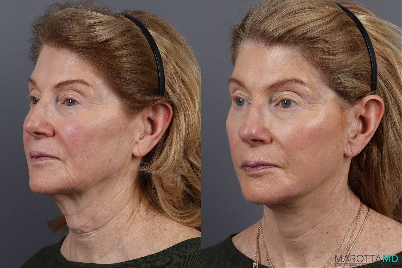 Facelift Neck Lift Before & After