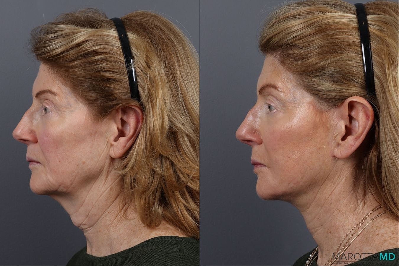 Facelift Neck Lift Before & After