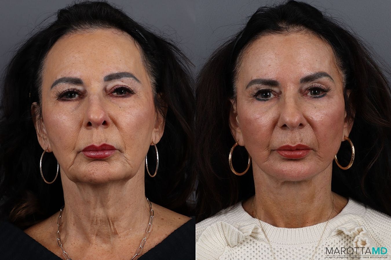 Facelift Neck Lift Before & After