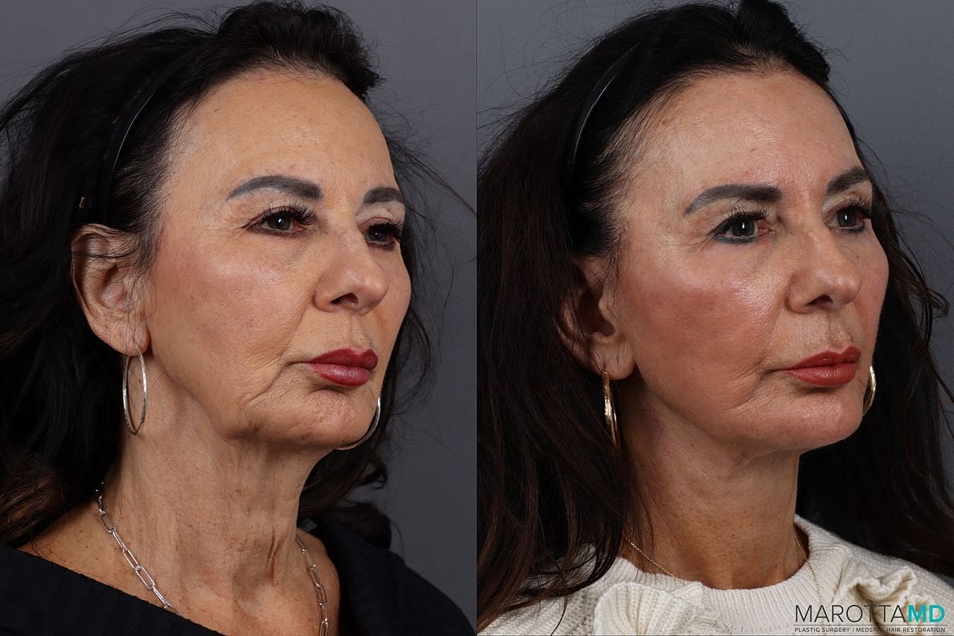 Facelift Neck Lift Before & After