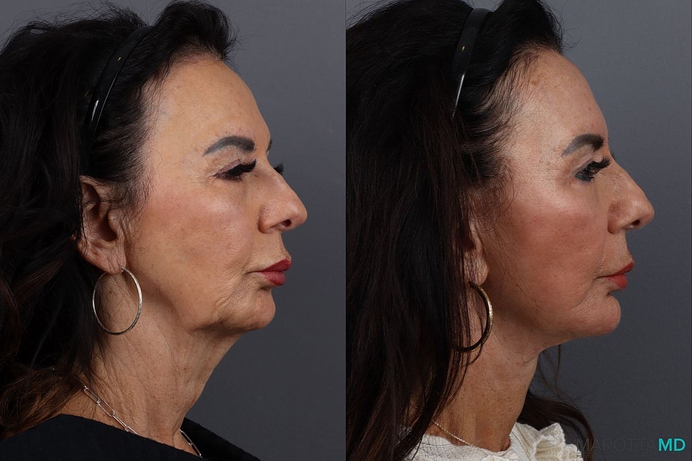 Facelift Neck Lift Before & After