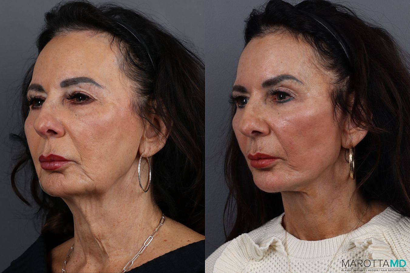 Facelift Neck Lift Before & After