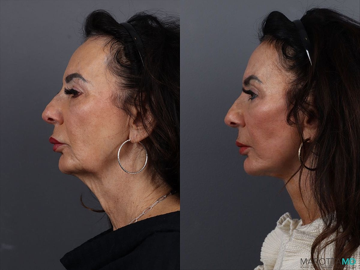 Facelift Neck Lift Before & After