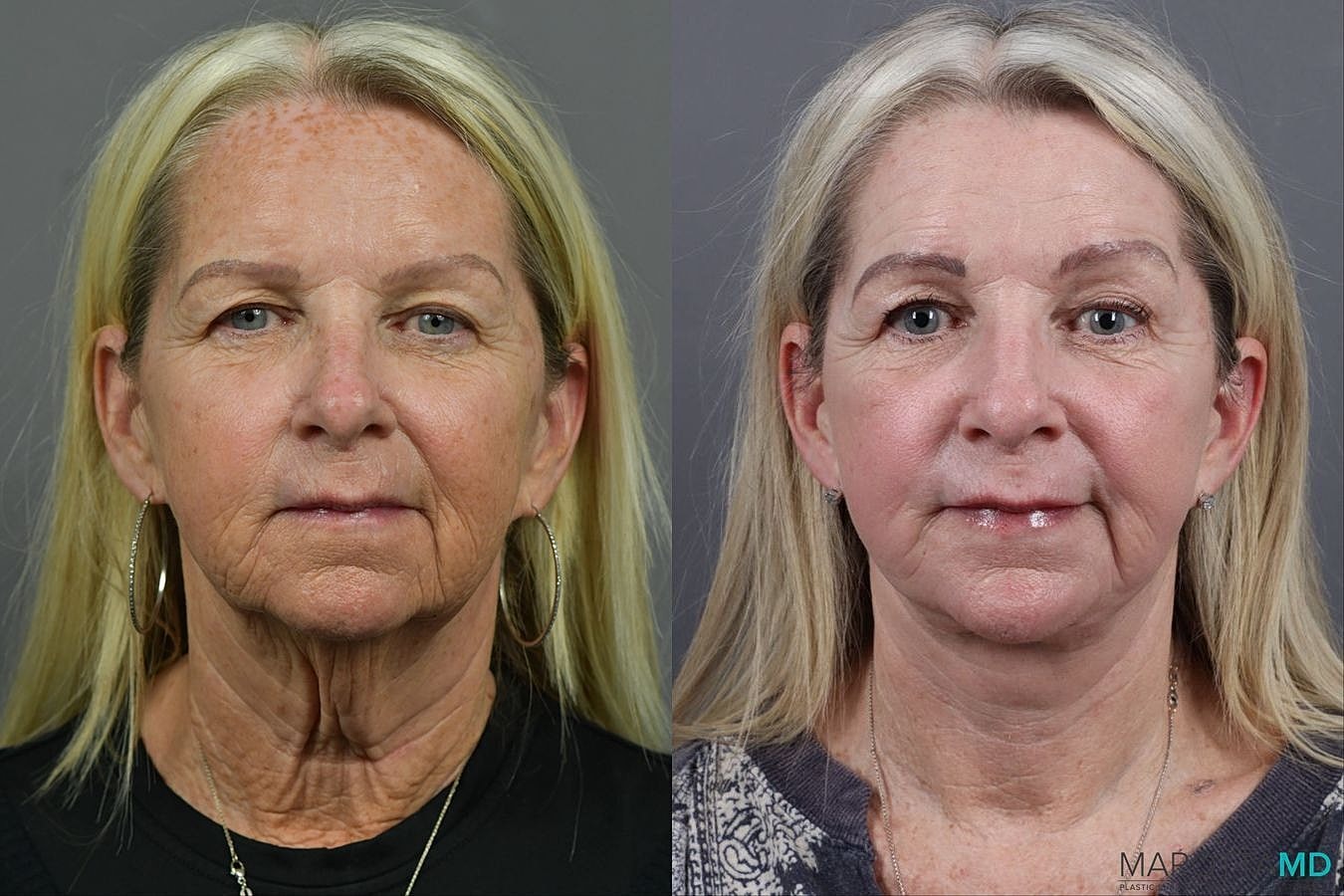 Facelift Neck Lift Before & After