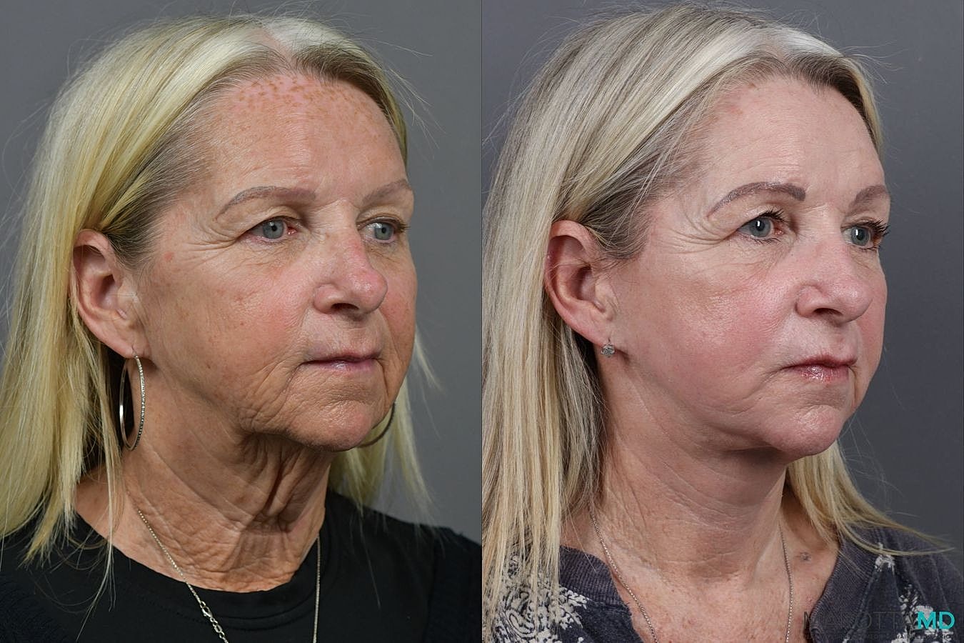 Facelift Neck Lift Before & After