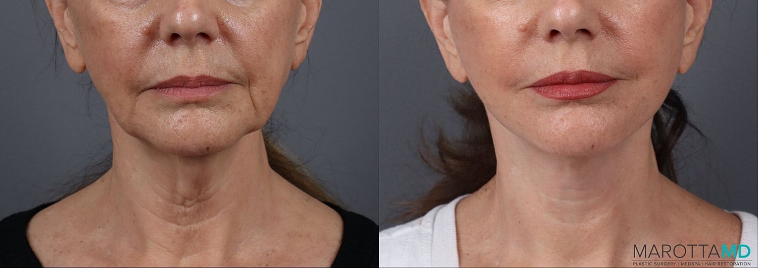 Facelift Neck Lift Before & After