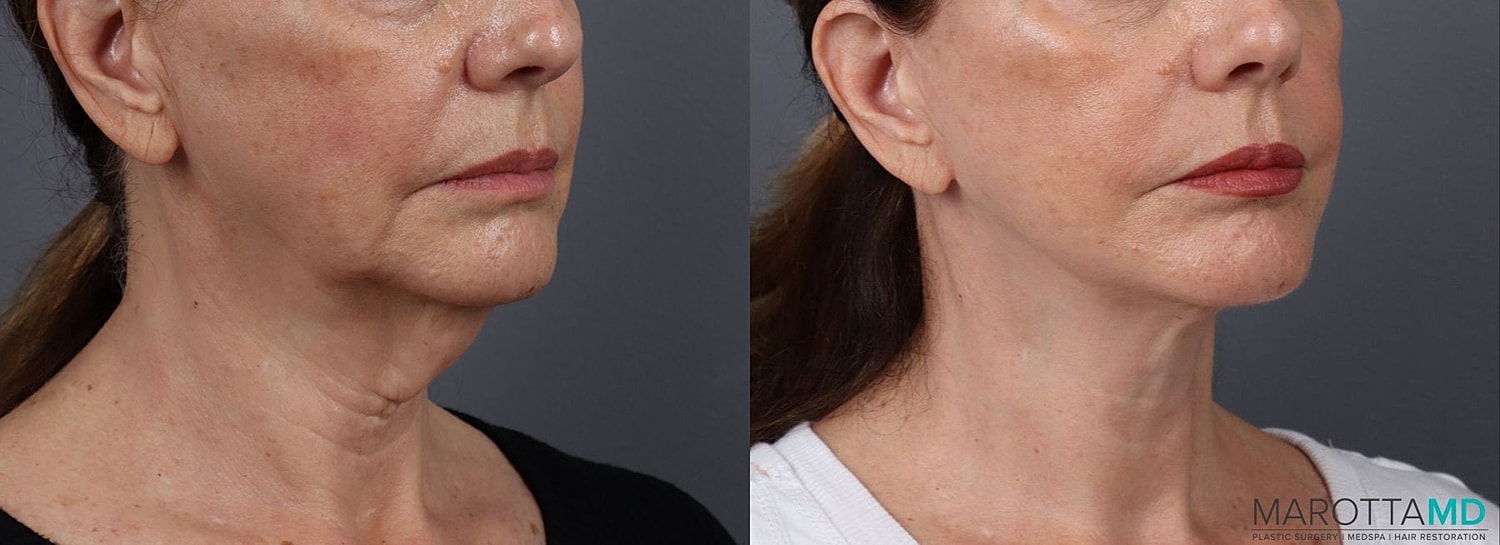 Facelift Neck Lift Before & After