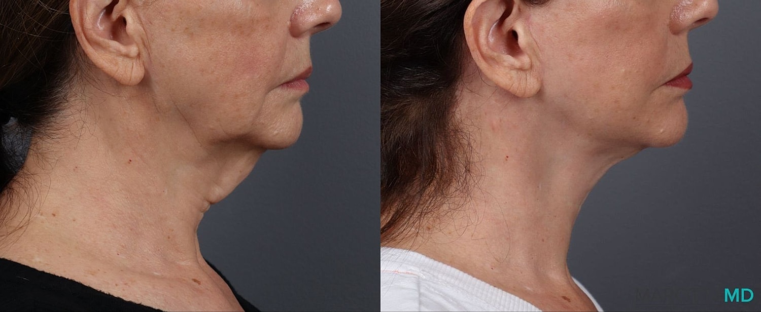 Facelift Neck Lift Before & After