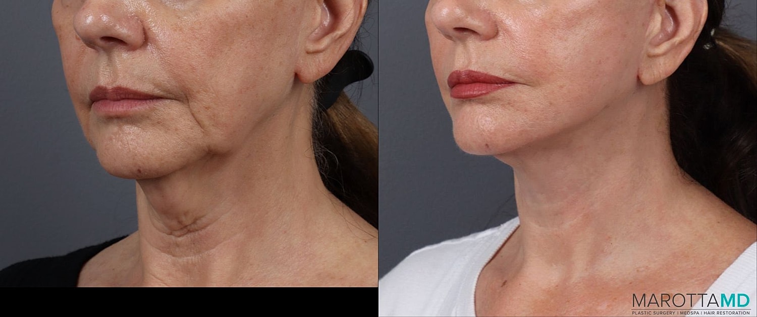 Facelift Neck Lift Before & After