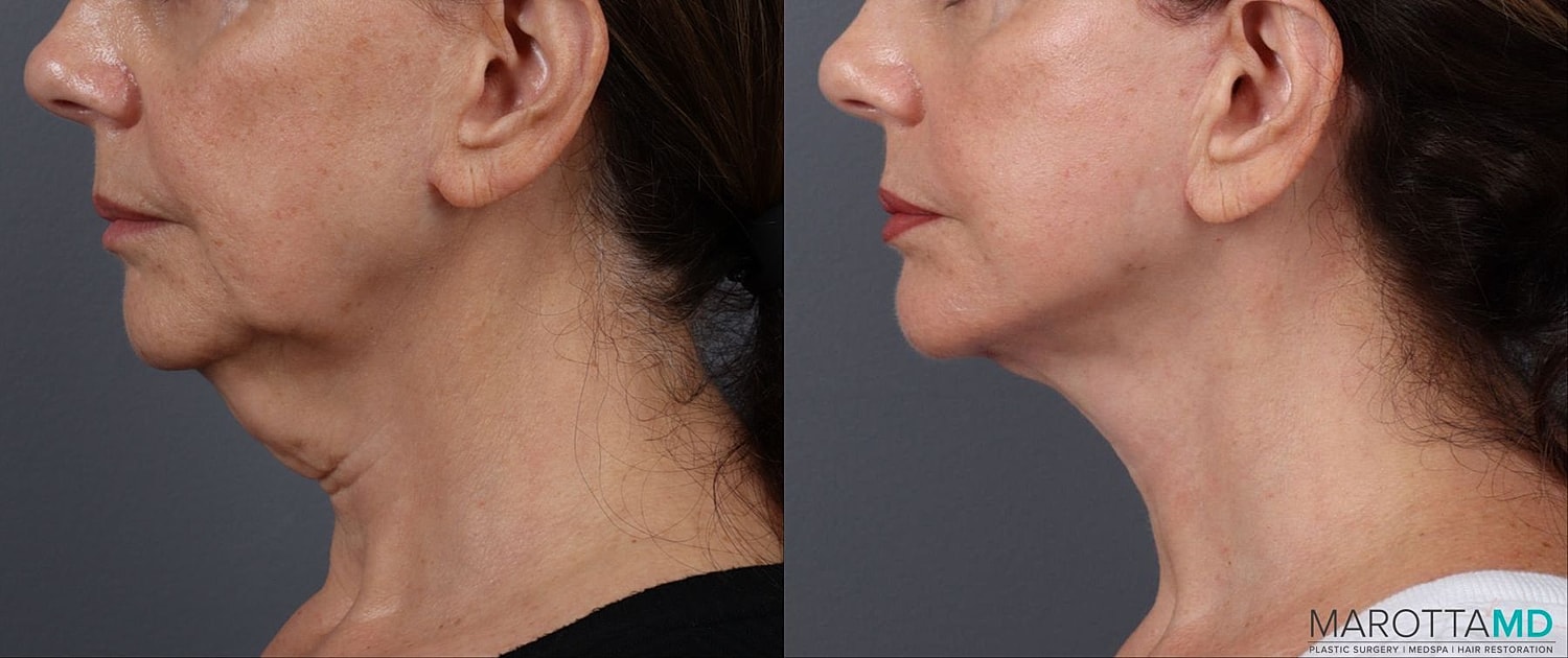 Facelift Neck Lift Before & After