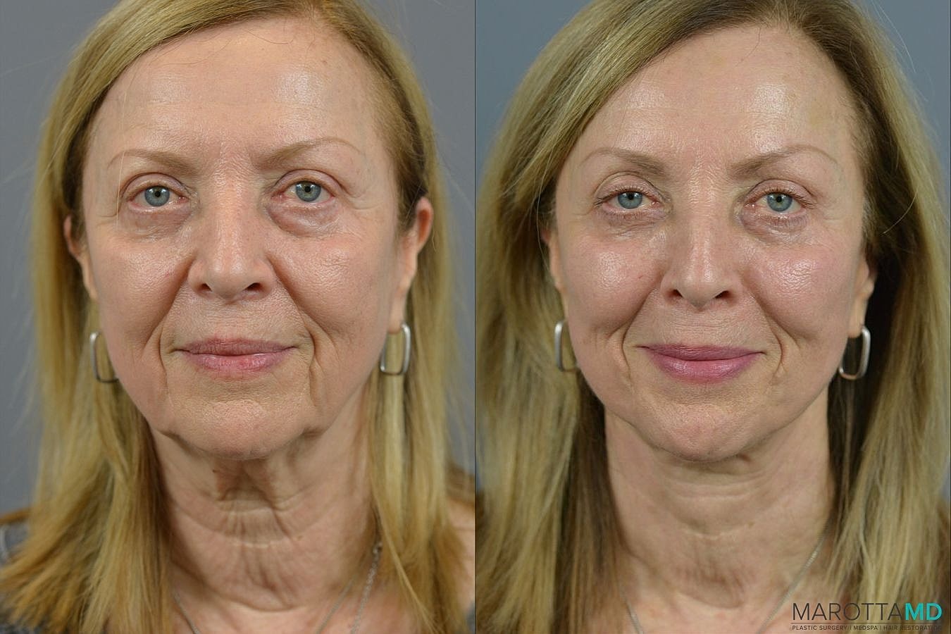 Facelift Neck Lift Before & After