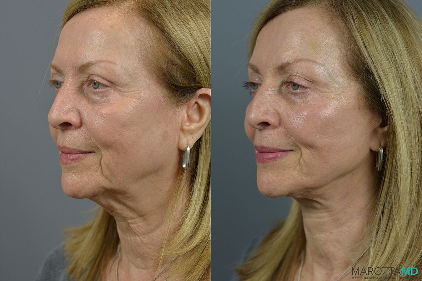 Facelift Neck Lift Before & After