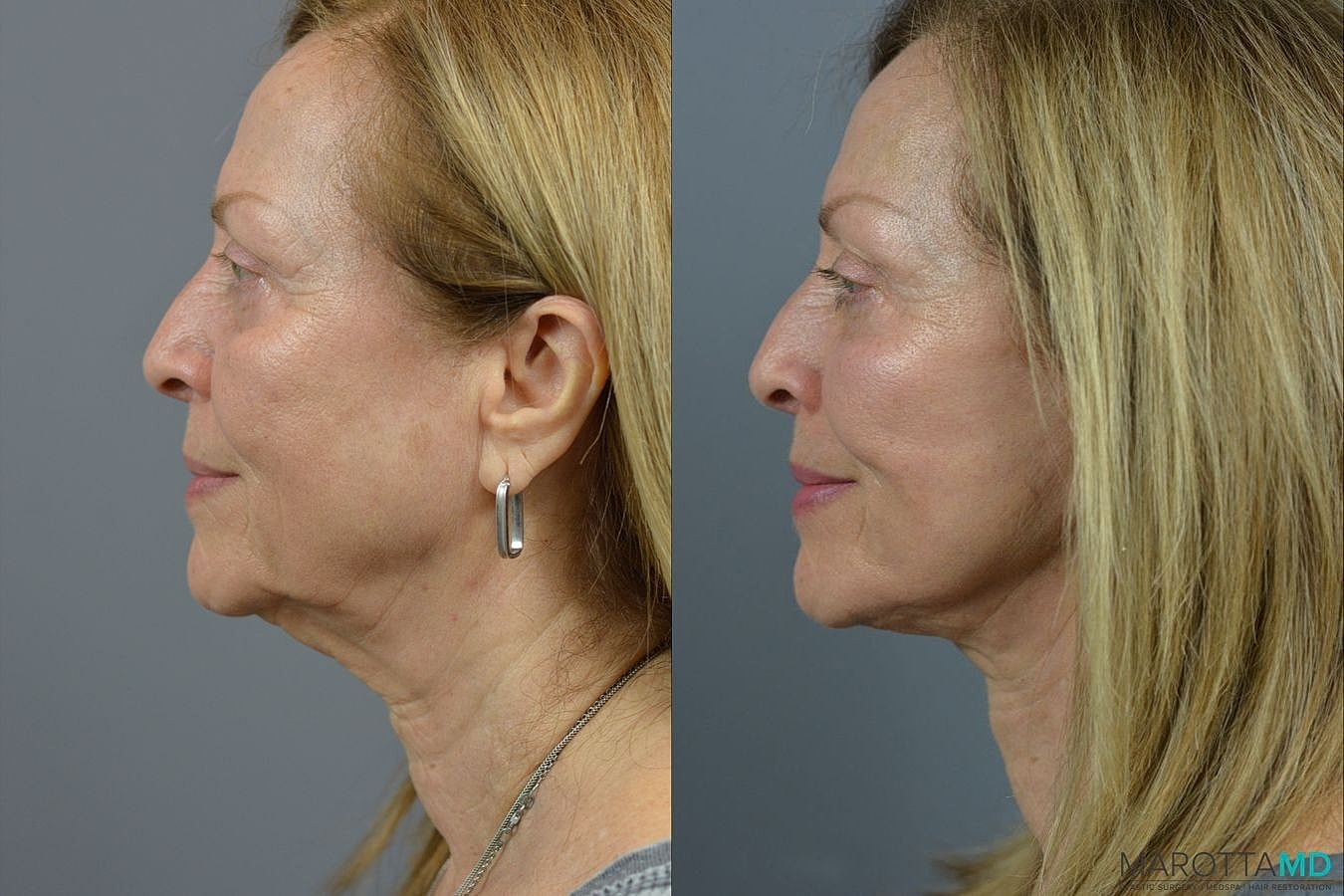 Facelift Neck Lift Before & After