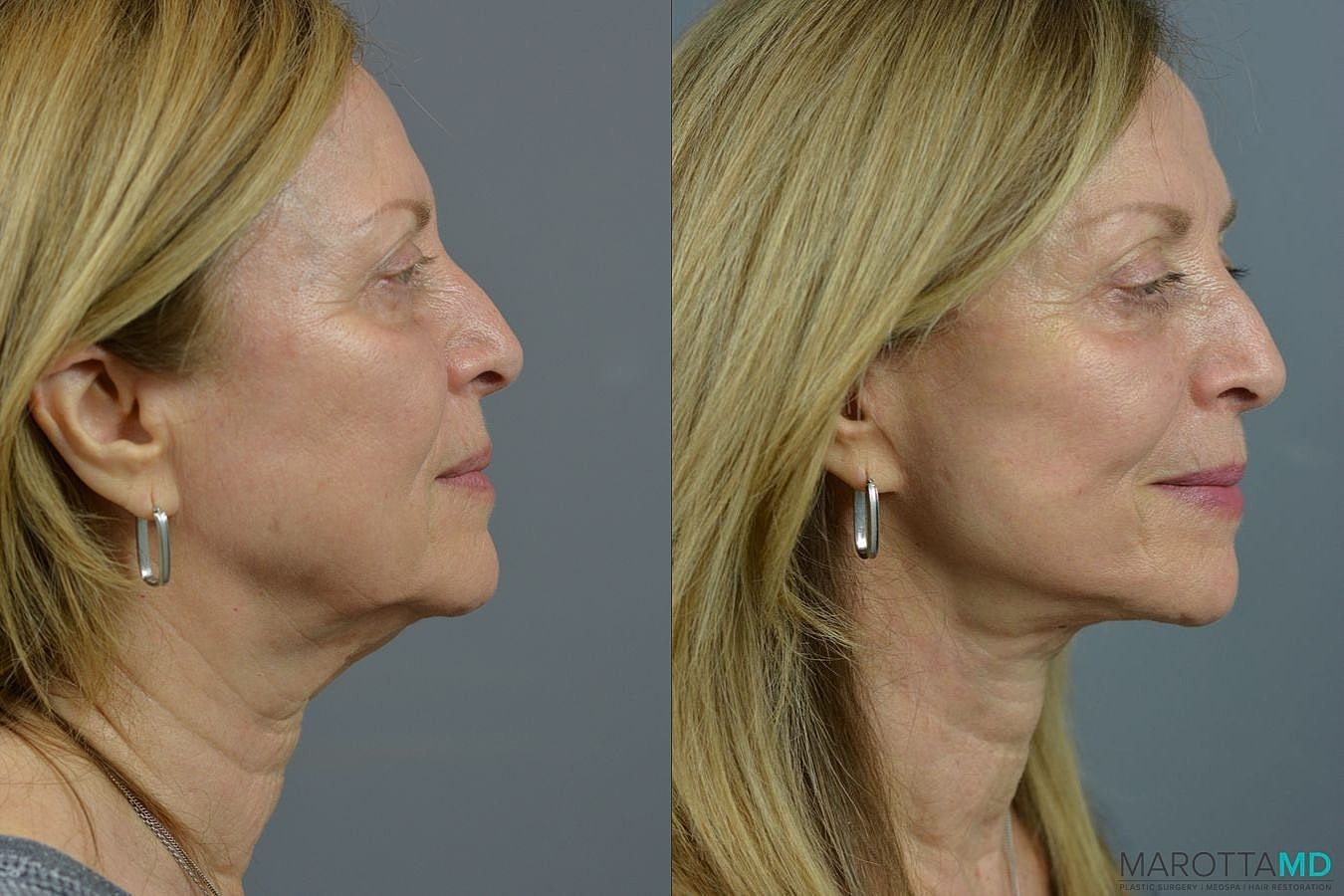 Facelift Neck Lift Before & After